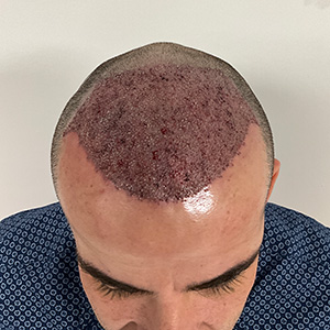 Loivwer patient: 1 day after hair transplant surgery photo