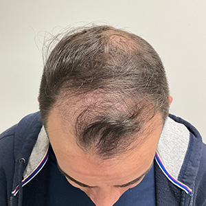 Loivwer patient: before hair transplant photo