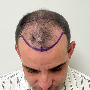 Loivwer patient: hair transplant surgery day photo