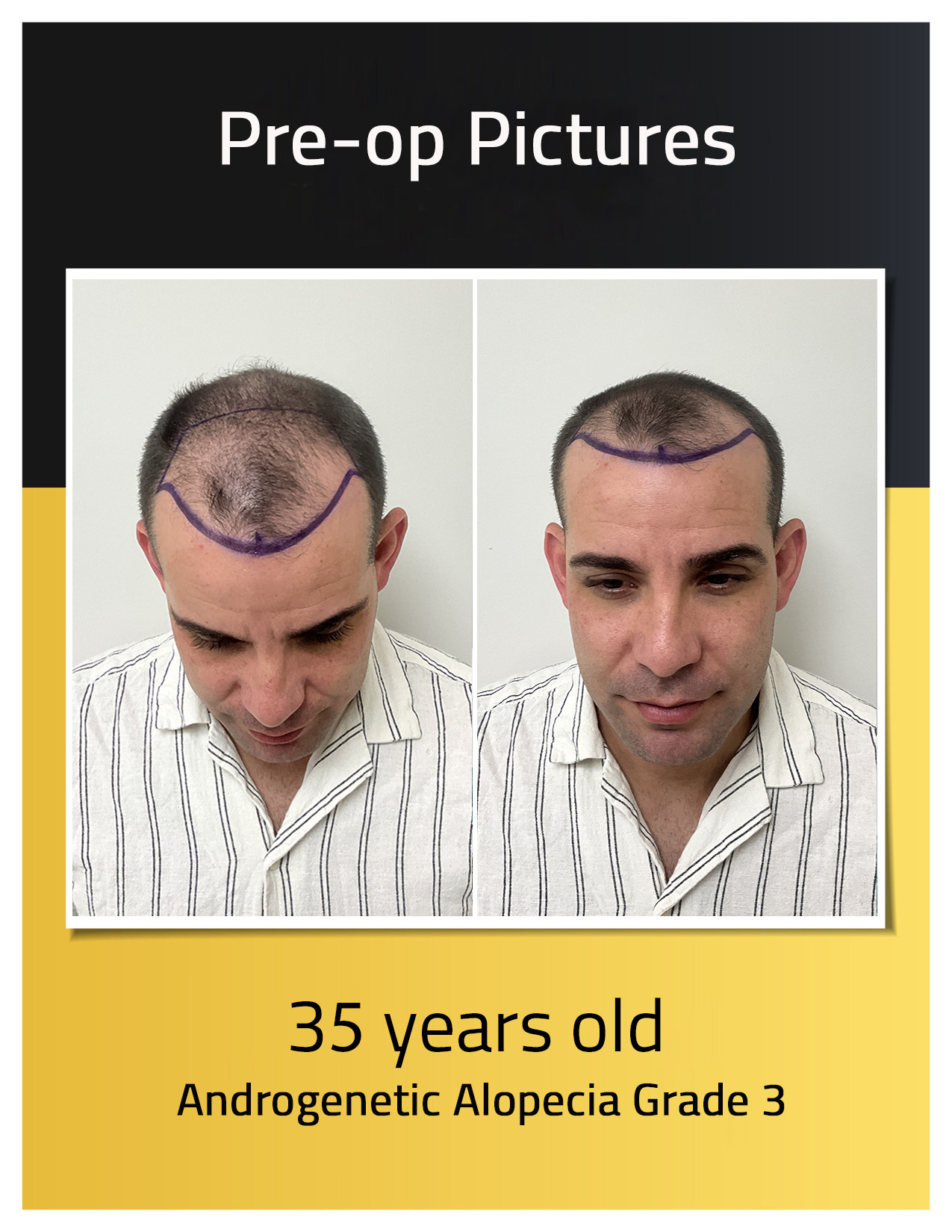 patient loivwer Androgenetic Alopecia pre-op photos