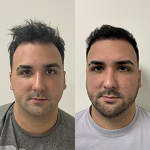 Miguel Hair Transplant result front