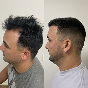 Miguel Hair Transplant result left side