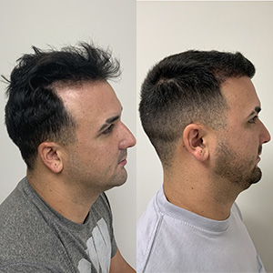 Miguel Hair Transplant Result right side