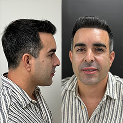 Angel hair transplant after photos