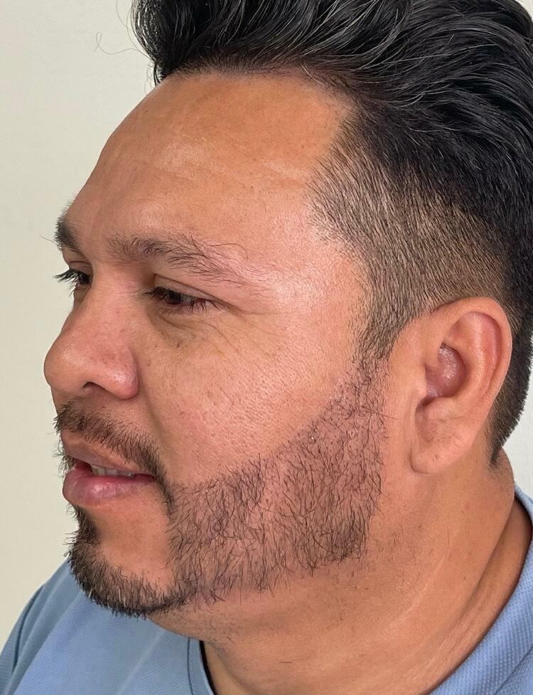 facial hair transplant after