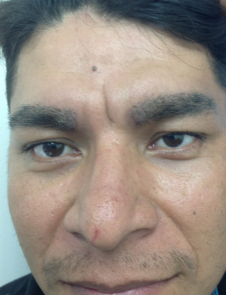 trasplante de cejas antes y despues