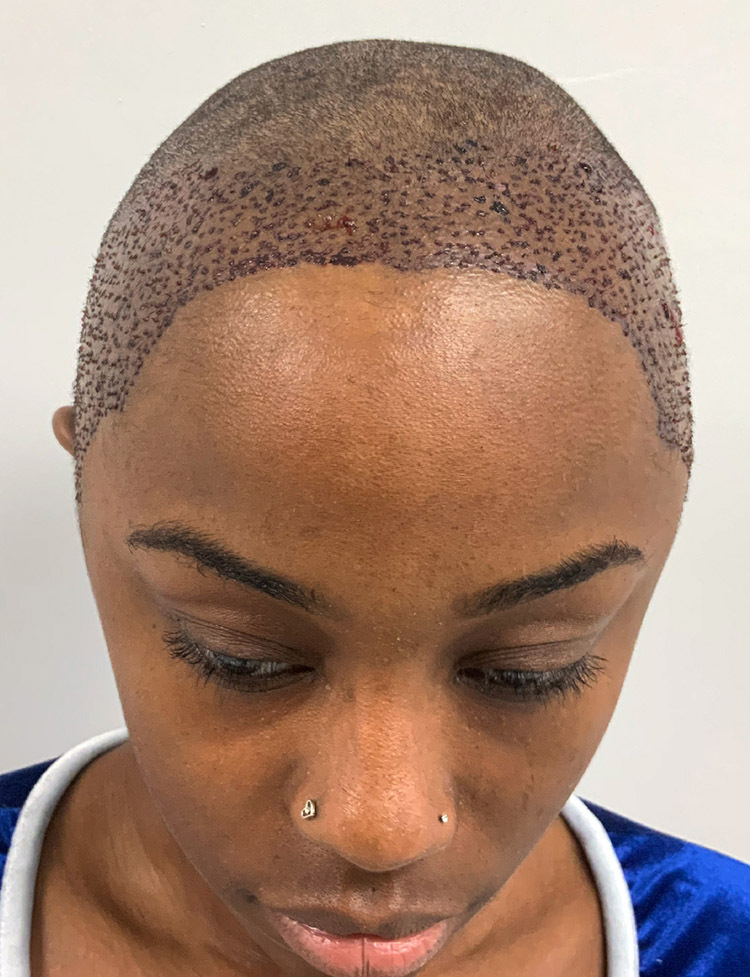 Ethnic female hair transplant after