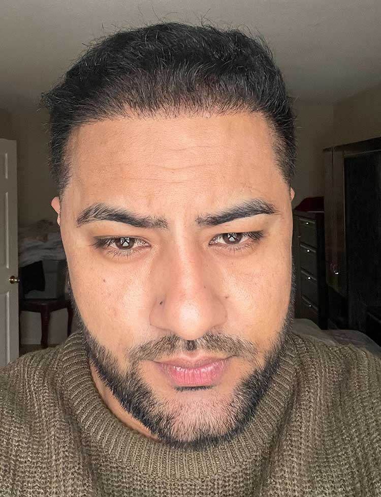 automated fue hair restoration after