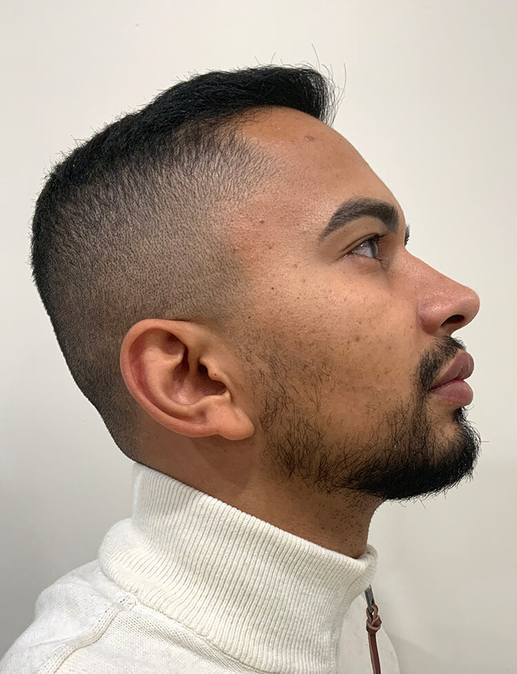 beard restoration before and after