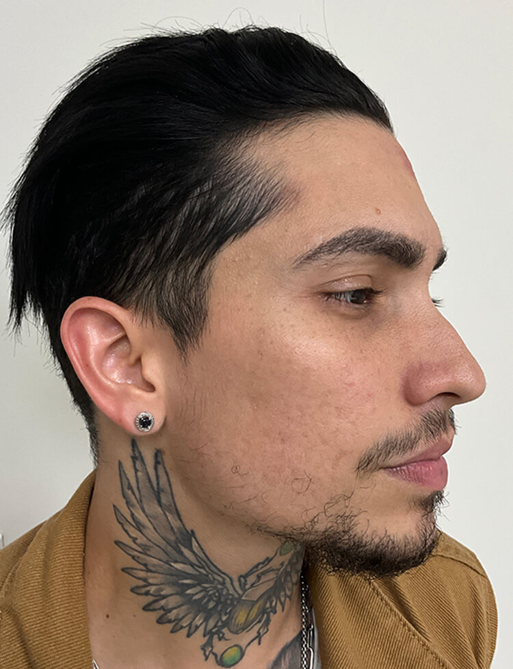 beard transplant before and after