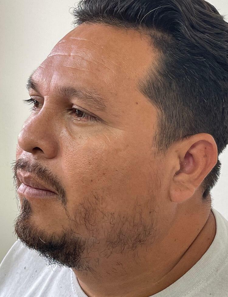 facial hair transplant before