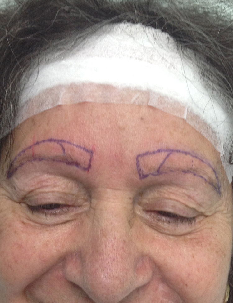 trasplante de cejas en Miami antes y despues