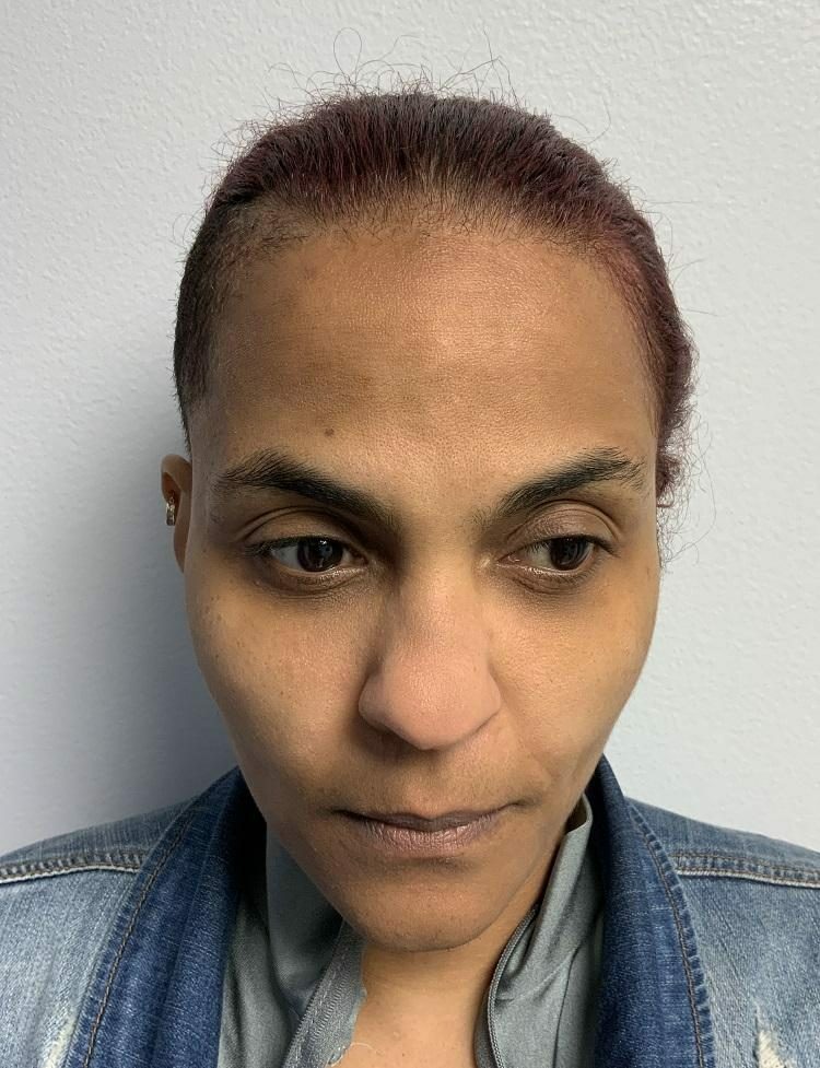 Female hair restoration in Miami before photo