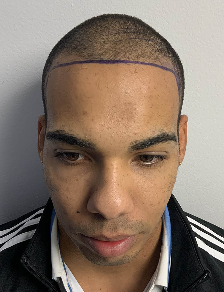 Ethnic Hair Transplant before