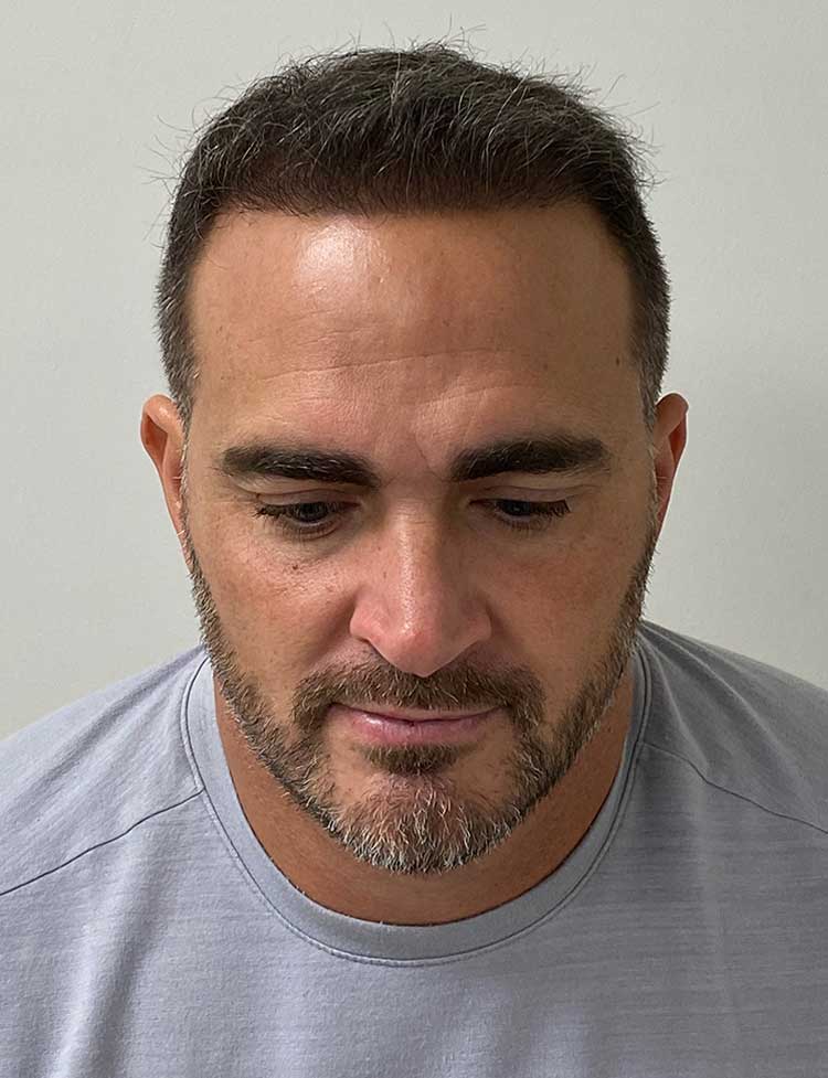 FUE hair transplant after