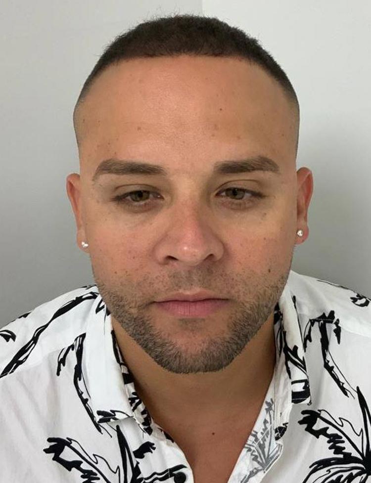 DHI hair restoration after photo