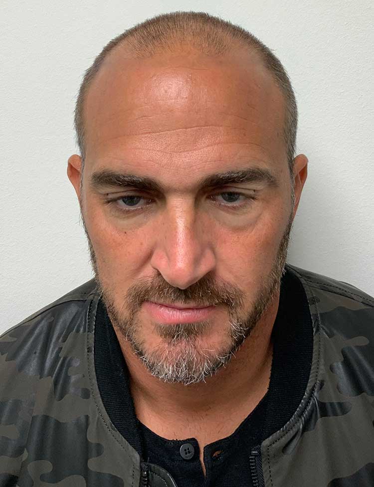 FUE hair transplant before