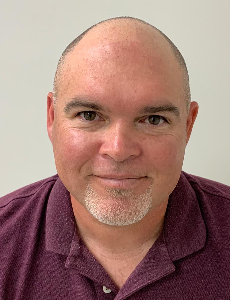 Sapphire FUE hair restoration before photo