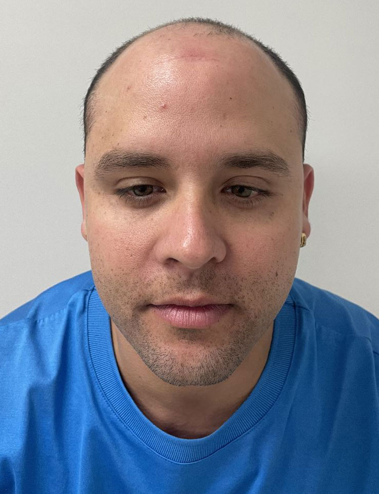 DHI hair restoration before photo