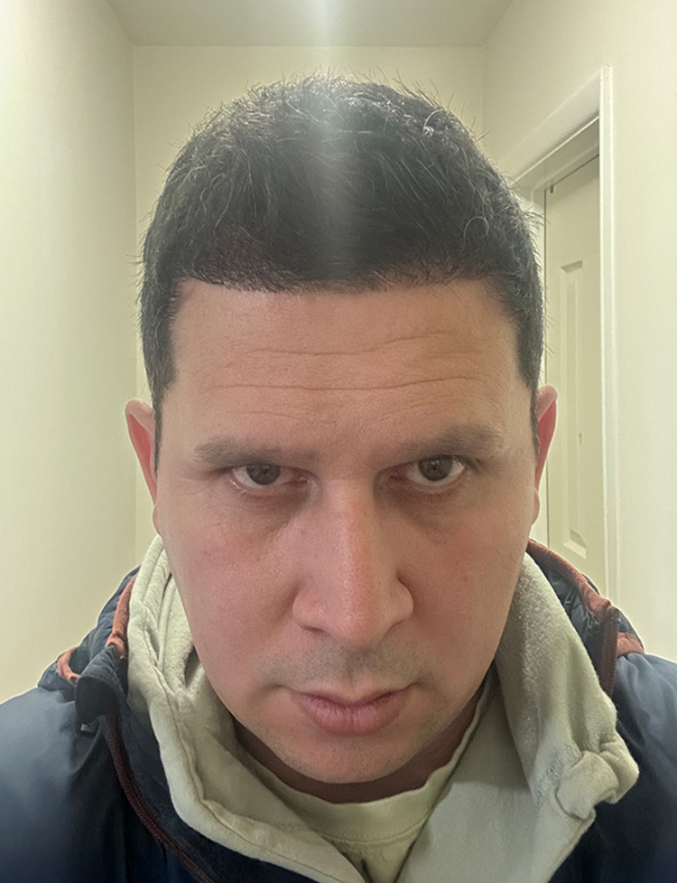 hair restoration before and after