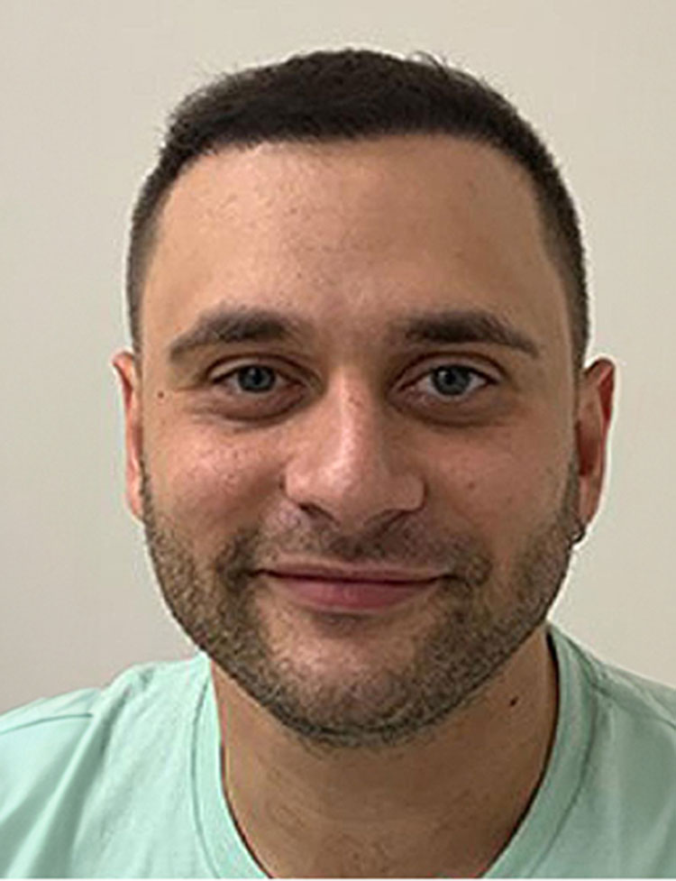 hair restoration real patient after