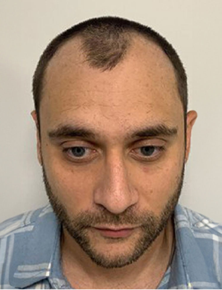 hair restoration real patient before