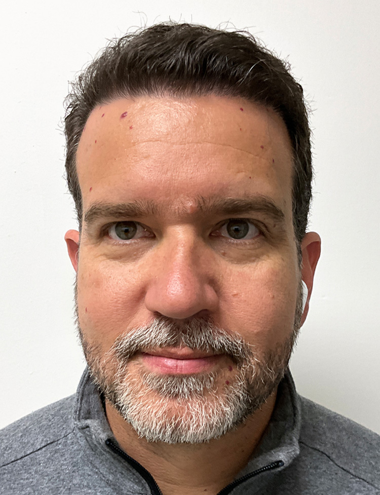 hair restoration before and after