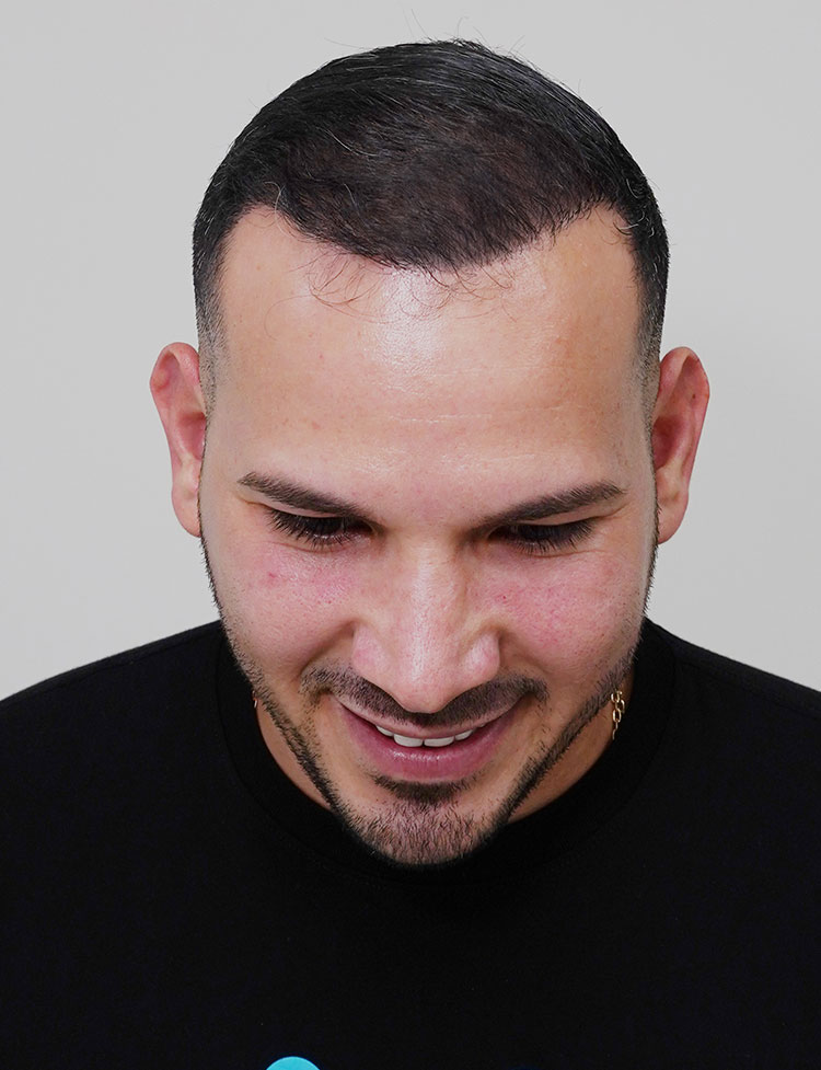 hair transplant after 2500 grafts