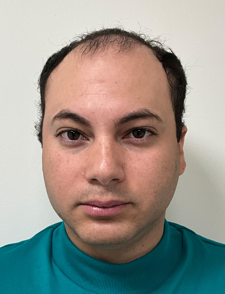 hair transplant Miami before