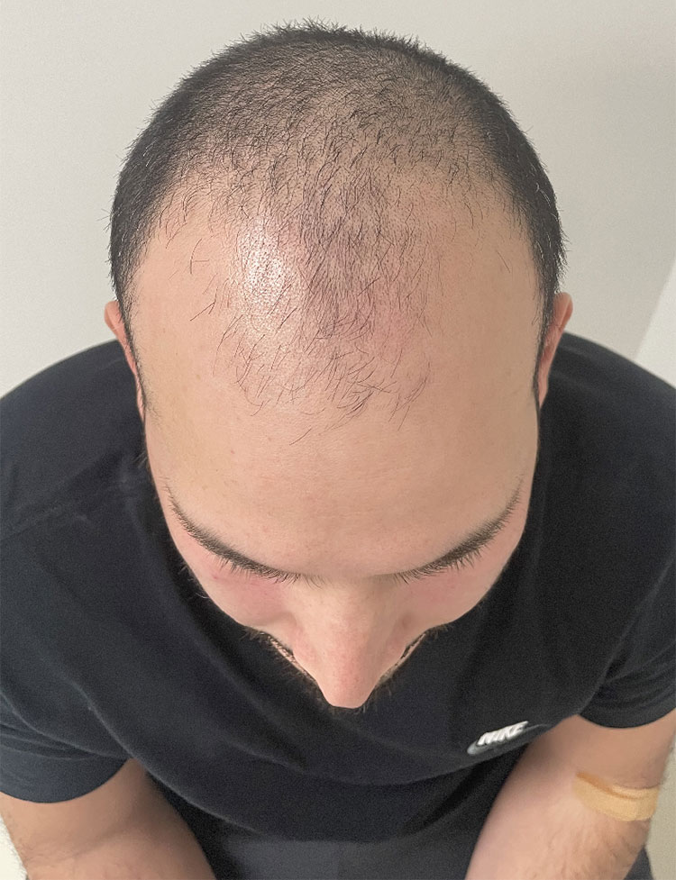 hair transplant before 2500 grafts