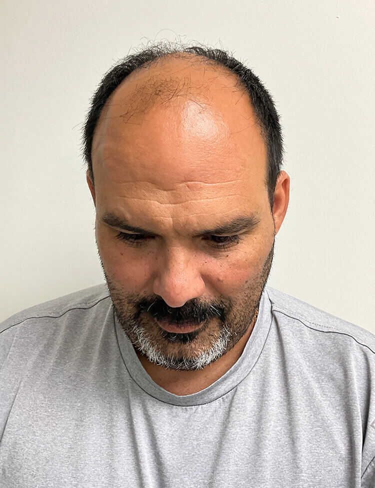 hair transplant before and after