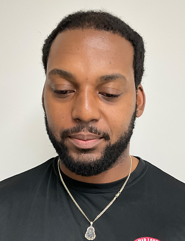 hair restoration Miami after