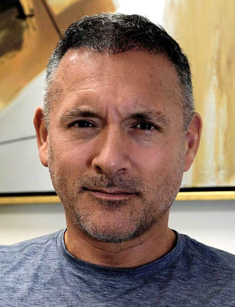 hairline restoration 1800 grafts after photo