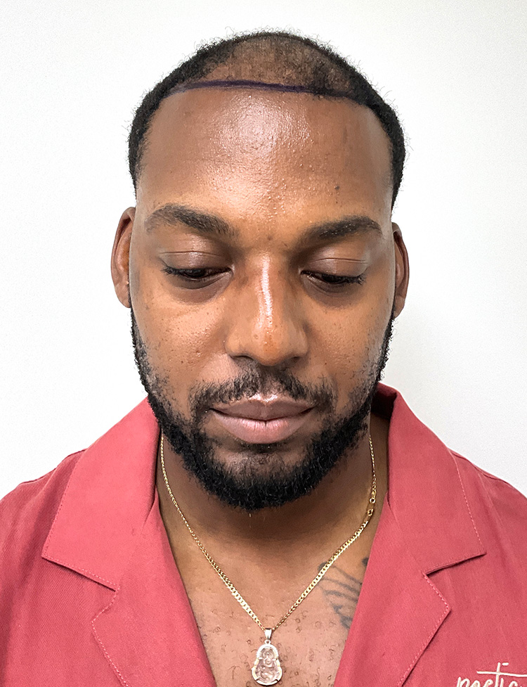 hair restoration Miami before