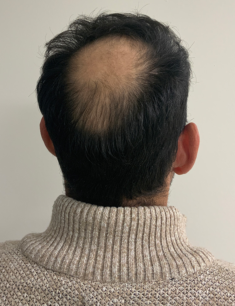 hair transplant before and after