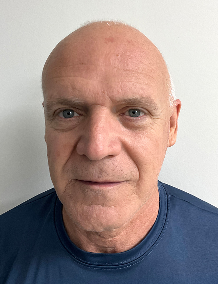 hair transplant before and after