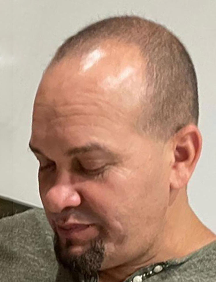 hair restoration 42 years old patient before photo