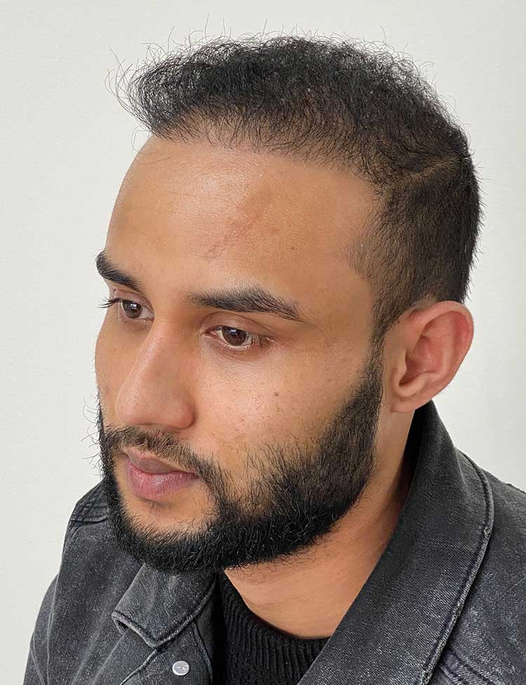 male hair transplant with neograft after photo