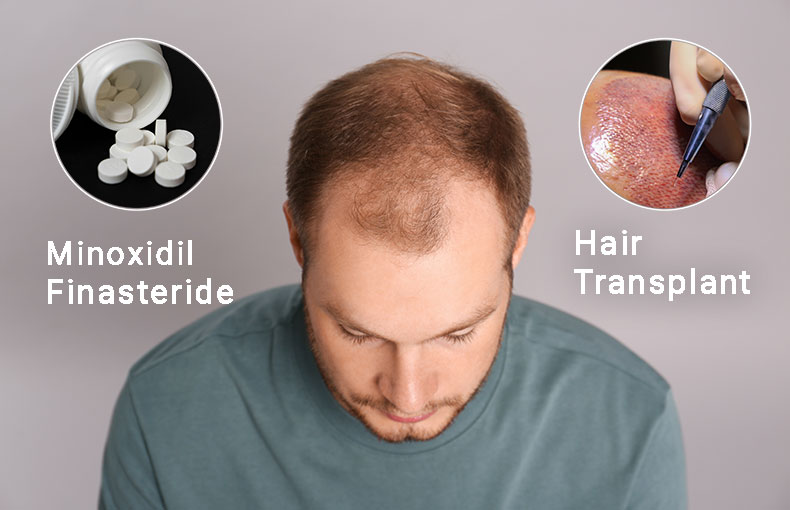 Hair Transplant or Hair Loss Medications?