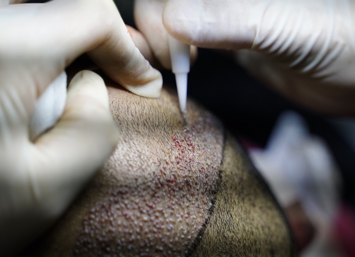 Latest hair transplant tools and techniques in 2021