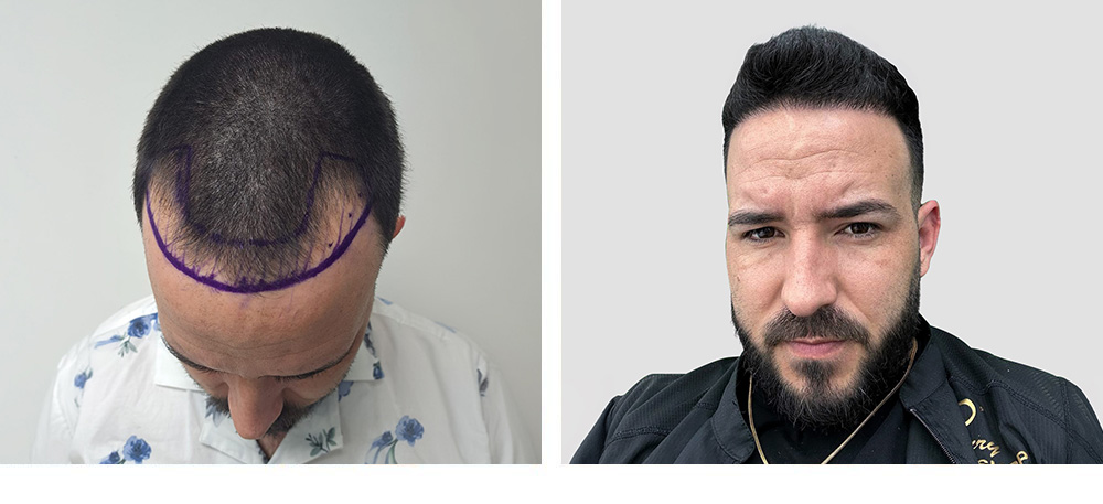 Hair Transplant Before and After