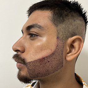 jorge beard reconstruction 1 day after surgery