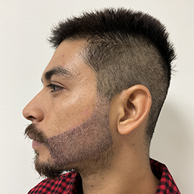 jorge beard reconstruction 1 week after