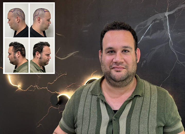 Eduardo Frómeta: 4000-follicles hair restoration patient story
