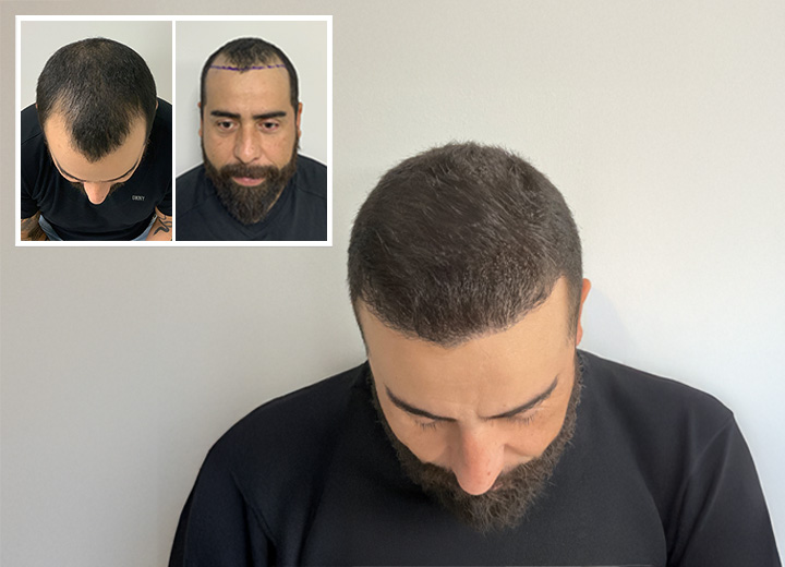 Enmanuel Larios y su Restauración Capilar con Care4Hair