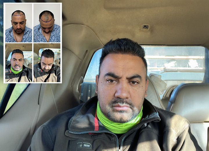 Gustavo Flores y su Transformación con el Método FUE de Care4Hair