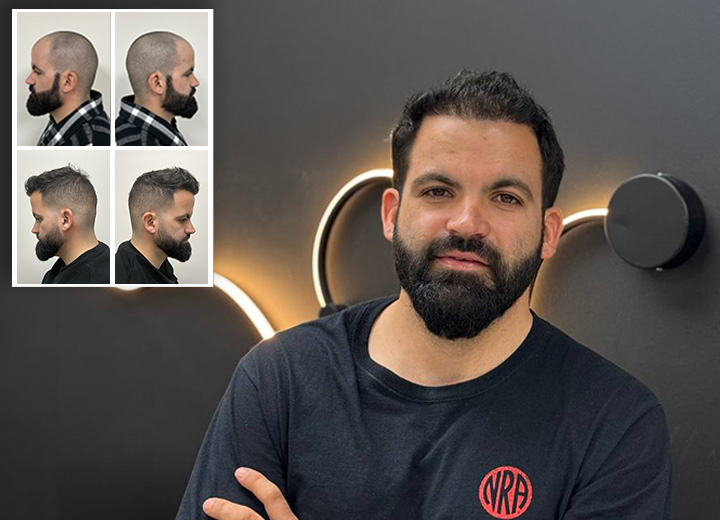 Hair Transplant of 3,500 Follicles in a 29 Year Old Patient