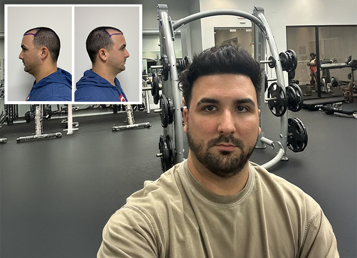 Miguel and his Story of Frontal FUE Hair Transplant with 3,500 Follicles