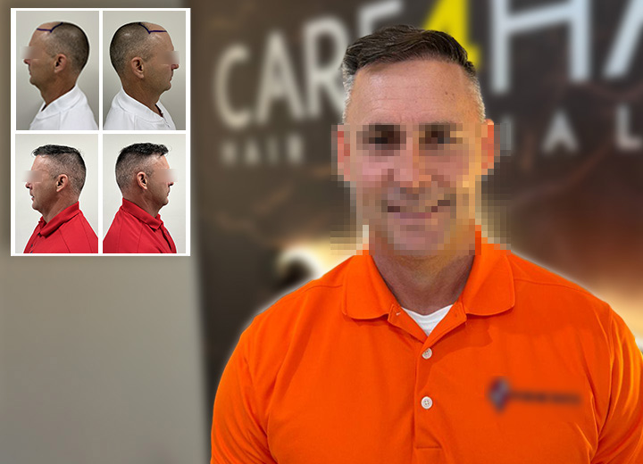 José Luis – Frontal Hair Transplant with 4,000 Follicles