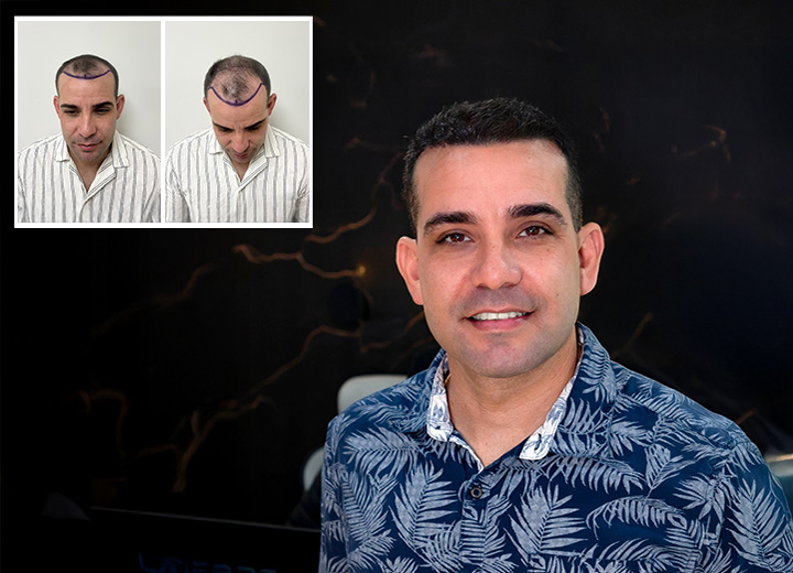 Loivwer y sus resultados tras el Implante de cabello con 3500 injertos